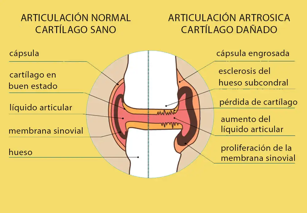 Ejemplo de una imagen donde se muestra la diferencia entre una rodilla sana, a una rodilla con artrosis dañada.