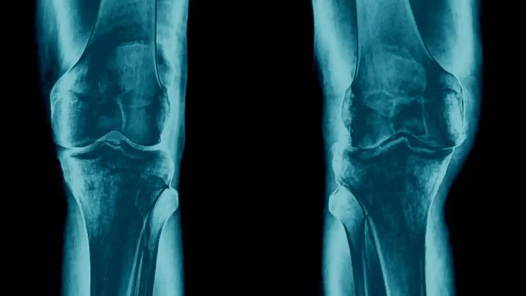 Radiografía de rodilla que presenta artrosis (osteoartritis)